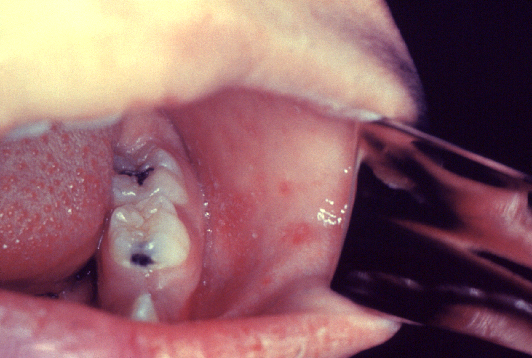 The image depicts Koplik spots on the buccal mucosa.