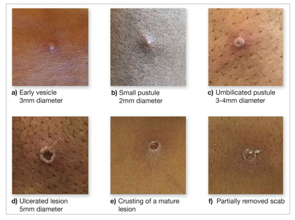 Image of mpox lesions in various stages of progression.