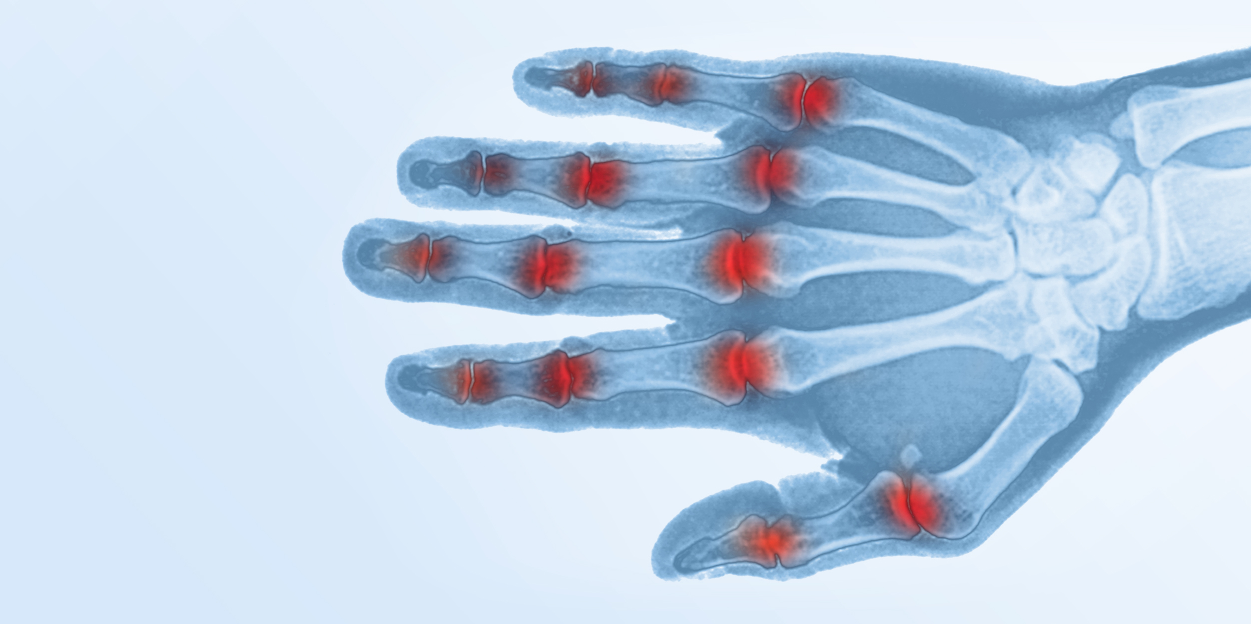 Inflammatory Arthritis