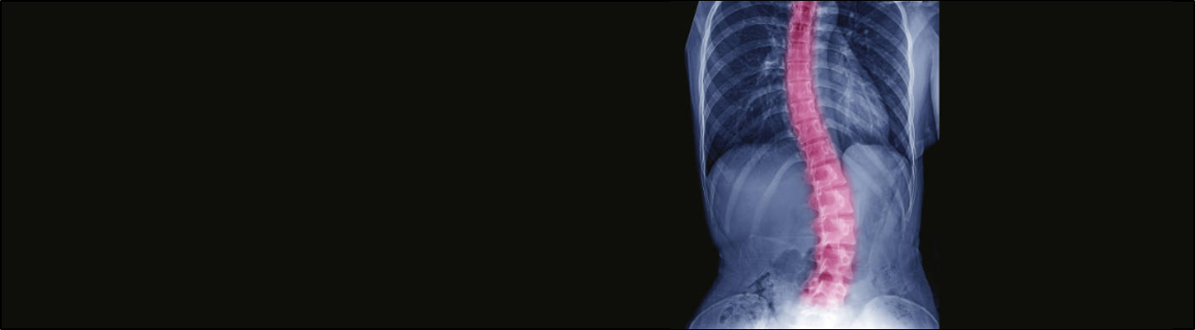 scoliosis