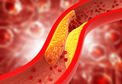 3D illustration showing clogged arteries, cholesterol plaque in artery.
