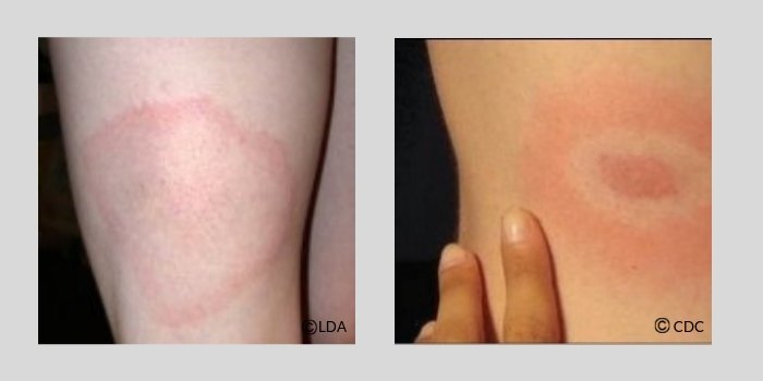 Two images of what Erythema migrans look like on an arm. A small localised area of redness may occur in response to a tick bi