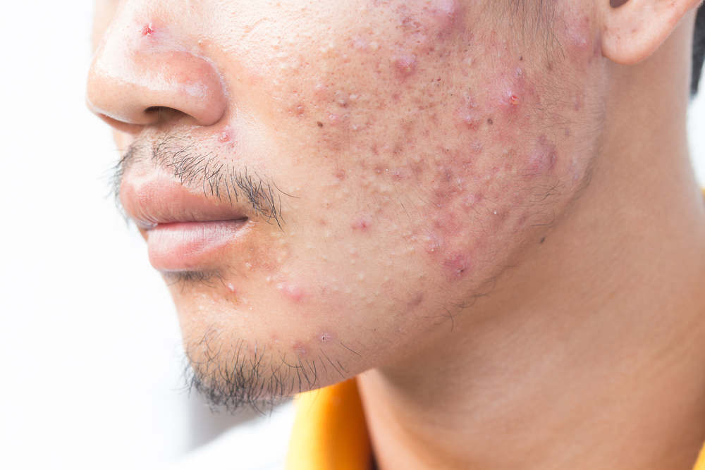 A close up image of a male face with acne on his cheek.
