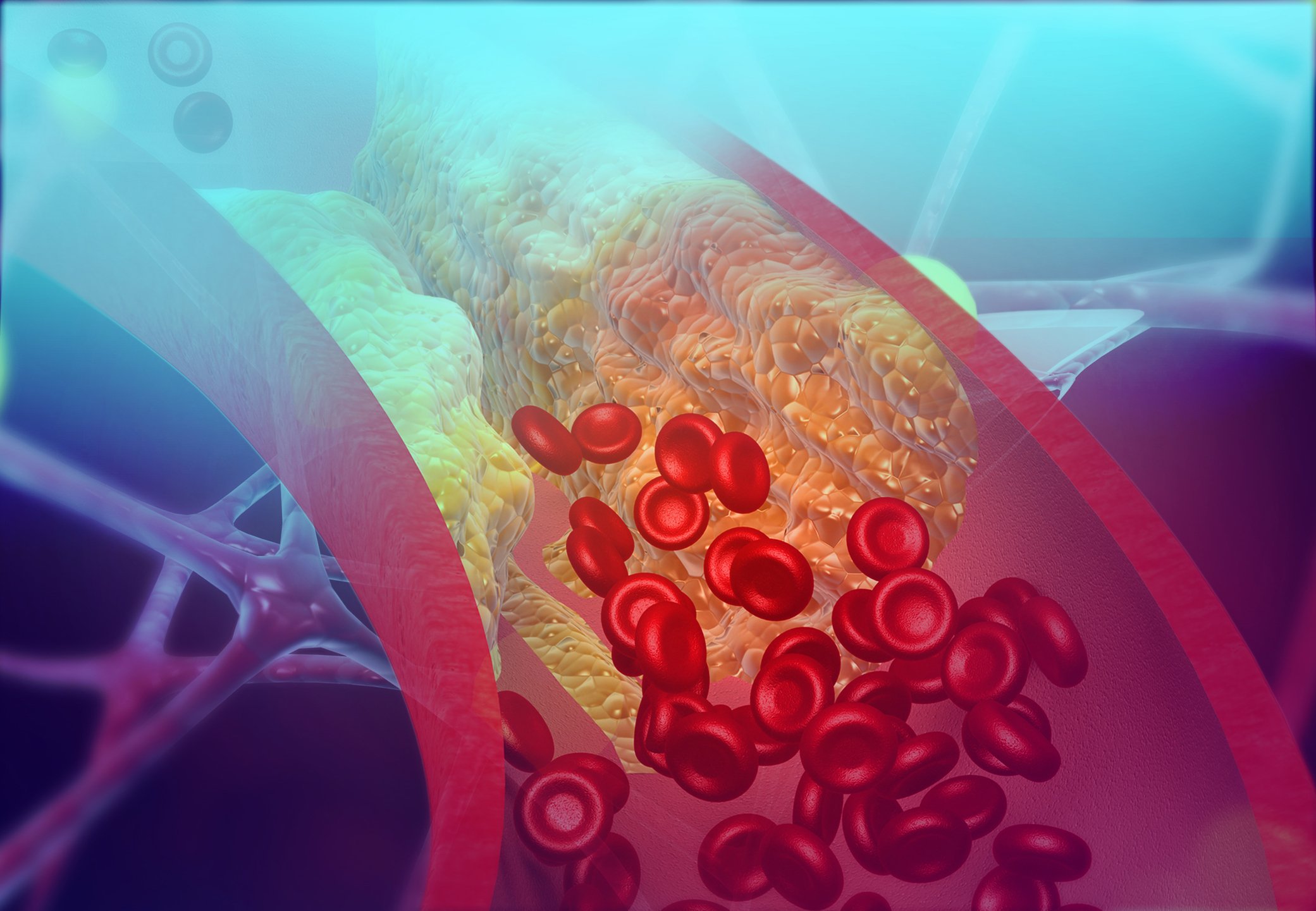 cholesterol blocking artery