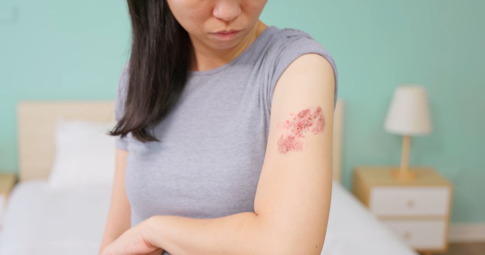 Female with shingles rash on arm