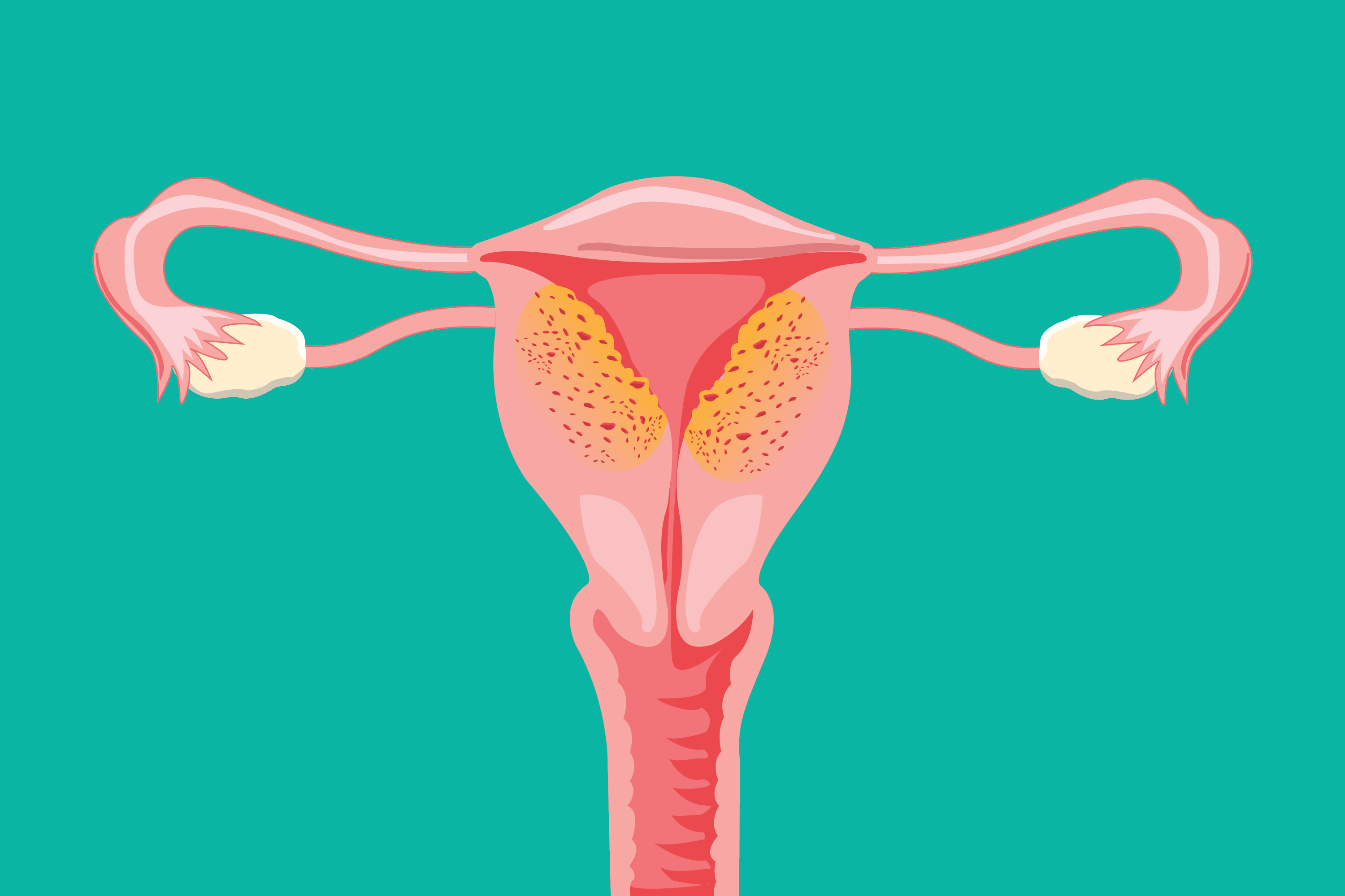 Adenomyosis and Endometriosis