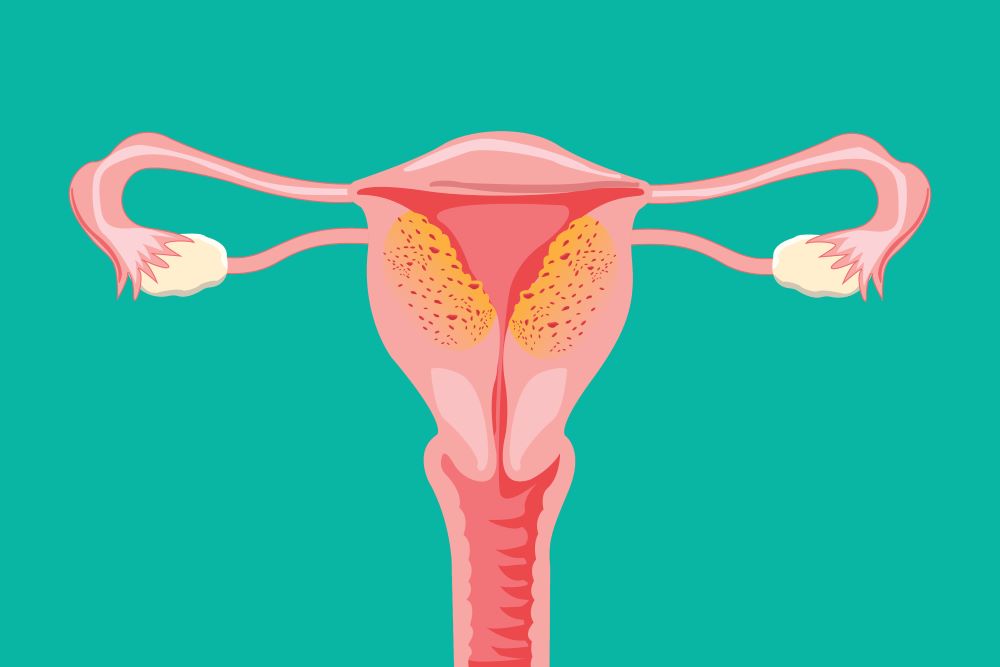 Adenomyosis and Endometriosis