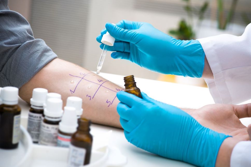 Image of skin prick allergy test.