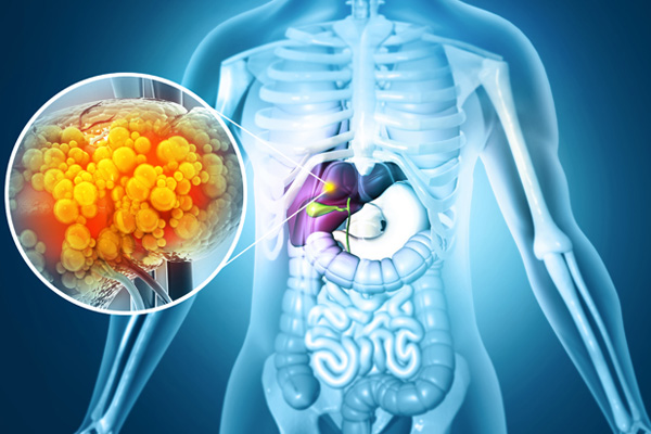 Fatty liver disease