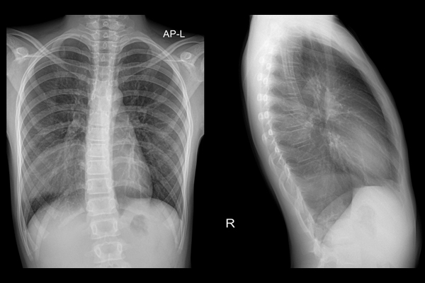 Antibiotic prescribing changes for pneumonia in children