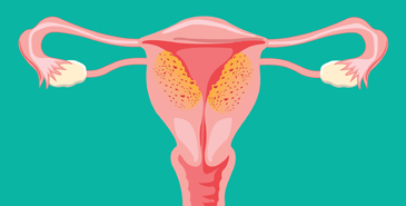 Adenomyosis and Endometriosis