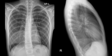 Antibiotic prescribing changes for pneumonia in children