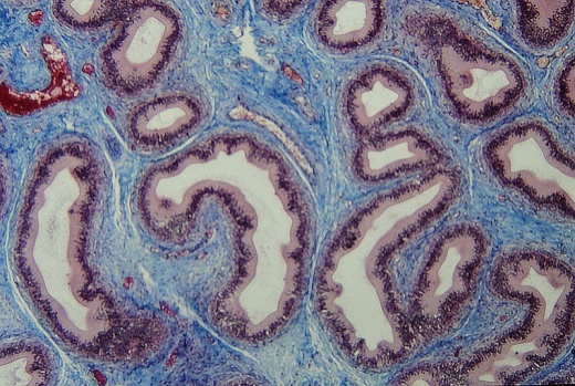 Zoom-in on cells showing connective tissue disorder